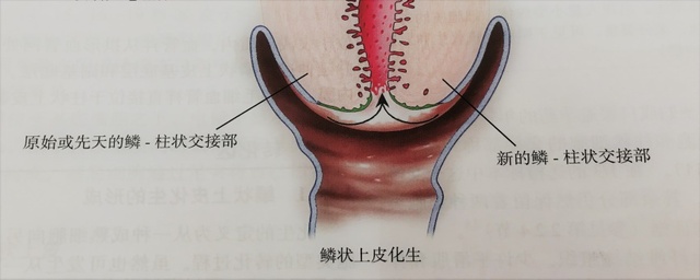 宮頸癌篩查沒(méi)那么簡(jiǎn)單，這些技巧助你提高取樣質(zhì)量