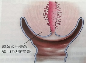 宮頸癌篩查沒(méi)那么簡(jiǎn)單，這些技巧助你提高取樣質(zhì)量